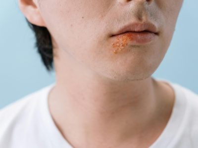 diseases that cause hives in adults