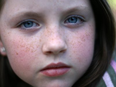 leukemia tiny red spots on skin